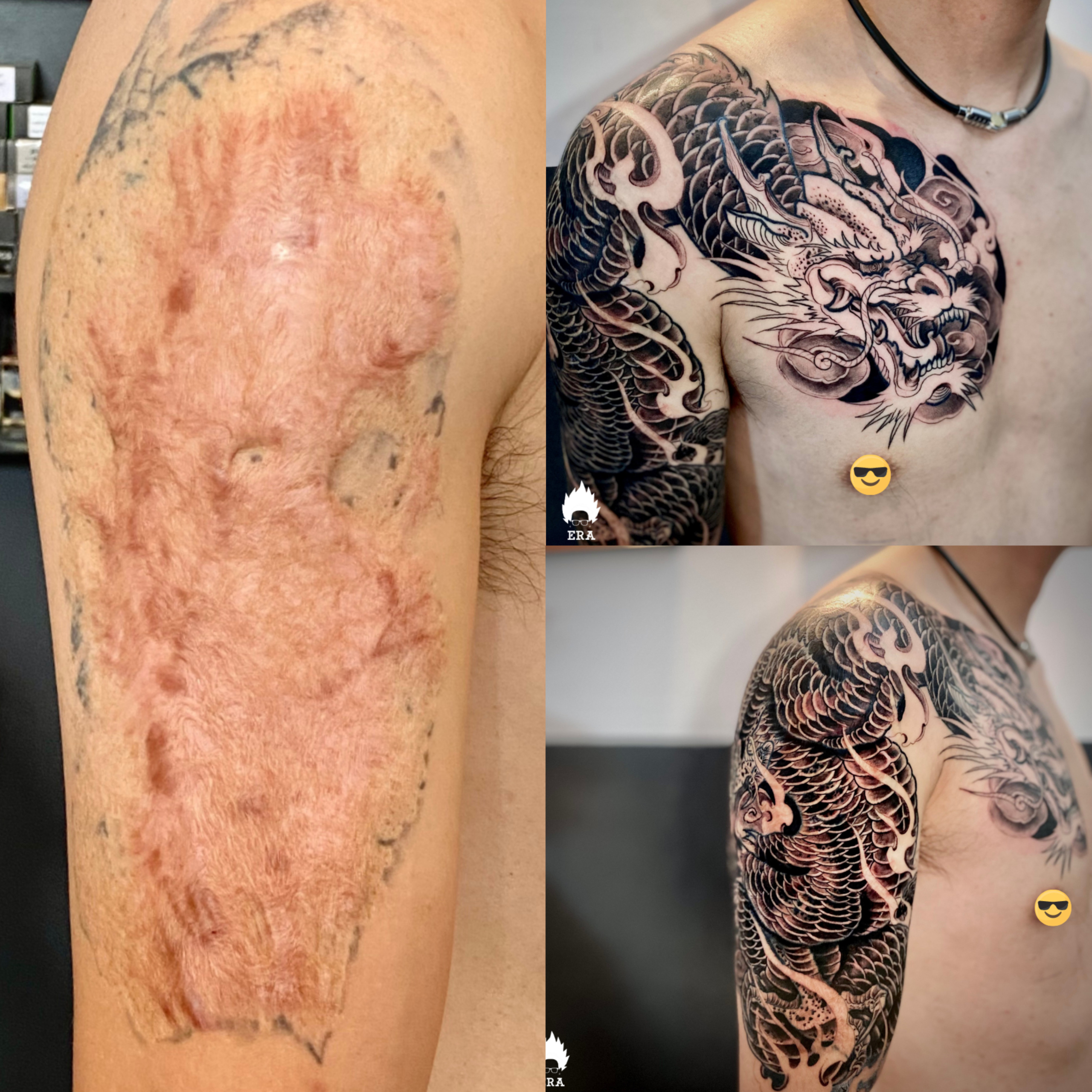 Xăm che sẹo hiệu quả