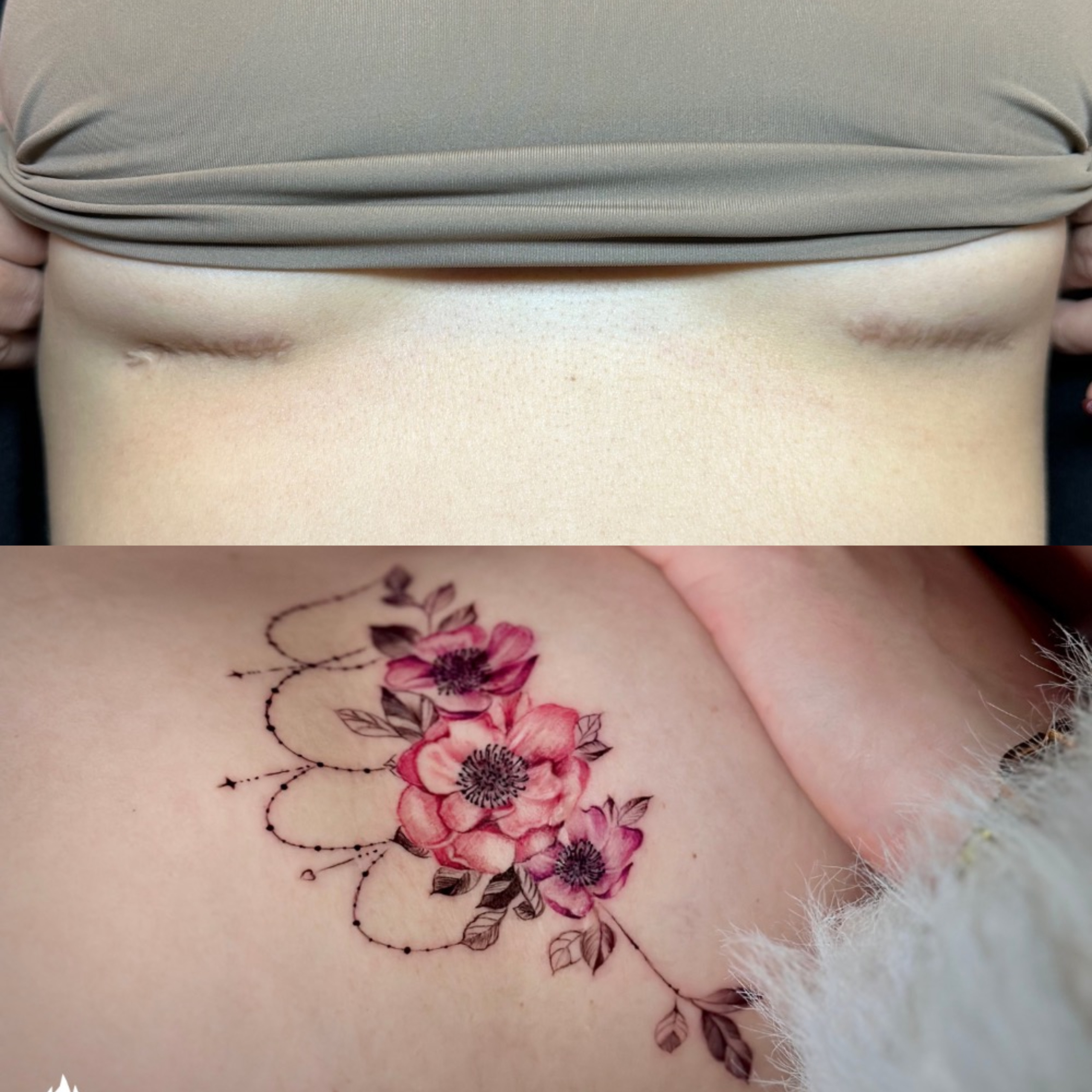 Xăm che sẹo ngực